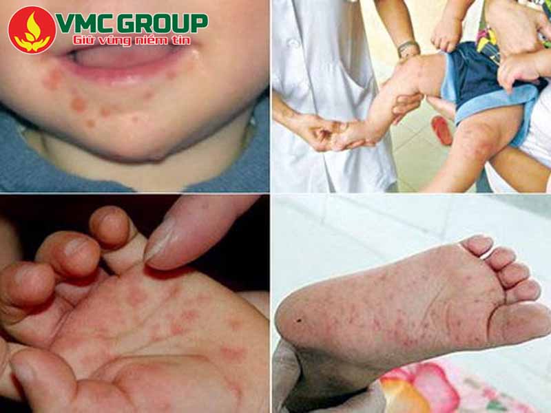 Cloramin B phòng chống bệnh tay chân miệng ở trẻ nhỏ