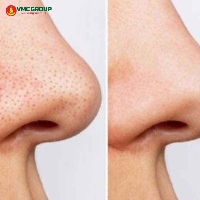 Bentonite hấp phụ dầu thừa và bã nhờn