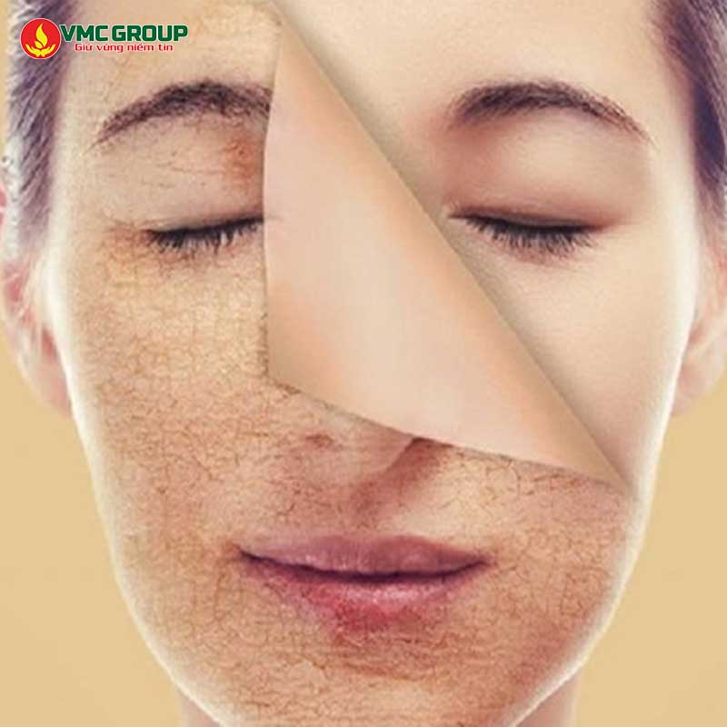 Bentonite loại bỏ tế bào chết
